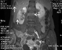 Imagistica prin Rezonanta Magnetica (IRM) in cancerul prostatic