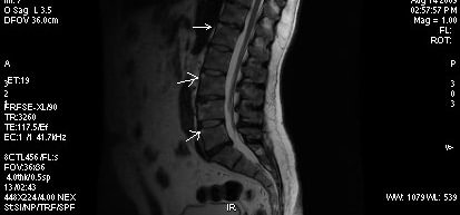 durere constantă la nivelul coloanei vertebrale sacrale)