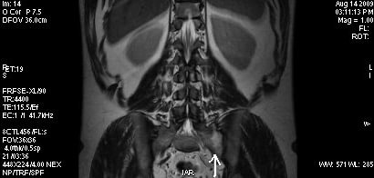 IRM Articulatii sacro-iliace si coxo-femurale, Artrita articulației sacroiliace