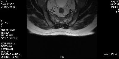 irm articulatii sacroiliace refacerea postoperatorie a articulației umărului
